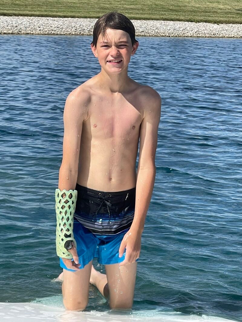 Patient at the lake wearing a FlexiOH waterproof cast, demonstrating waterproof capability